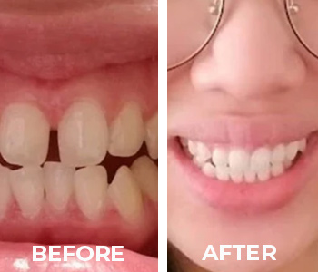 before_after_patient_4